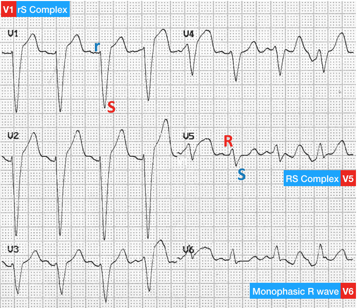 ECG LBBB changes in precordial leads