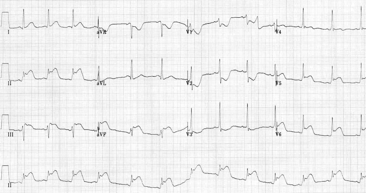 ECG Inferolateral STEMI proximal circumflex artery occlusion