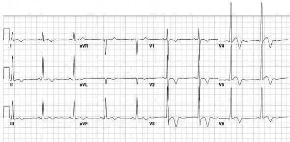 Hypertrophic Cardiomyopathy (HCM)