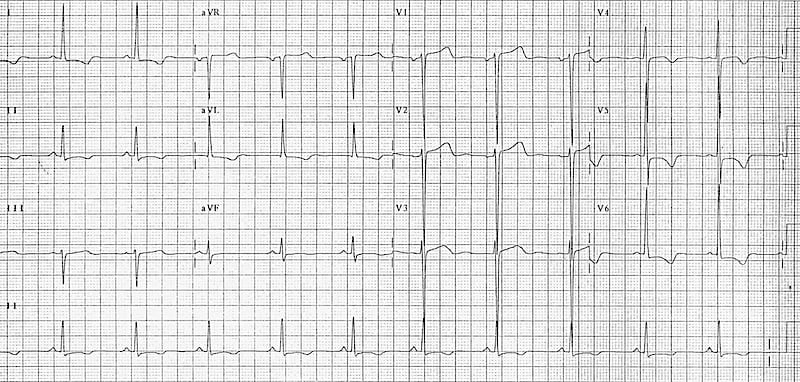Left ventricular hypertrophy with T-wave inversion