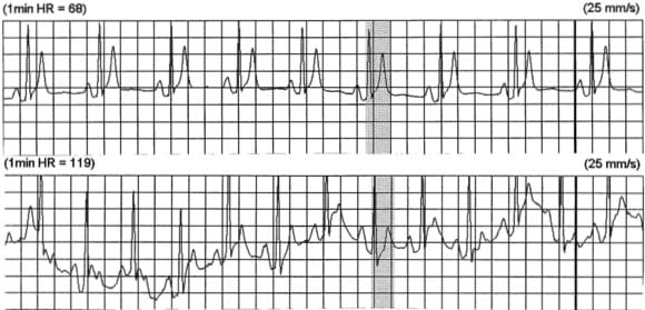 Holter SQTS syndrome