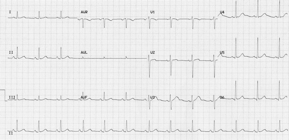 benign-early-repolarisation-faster-HR