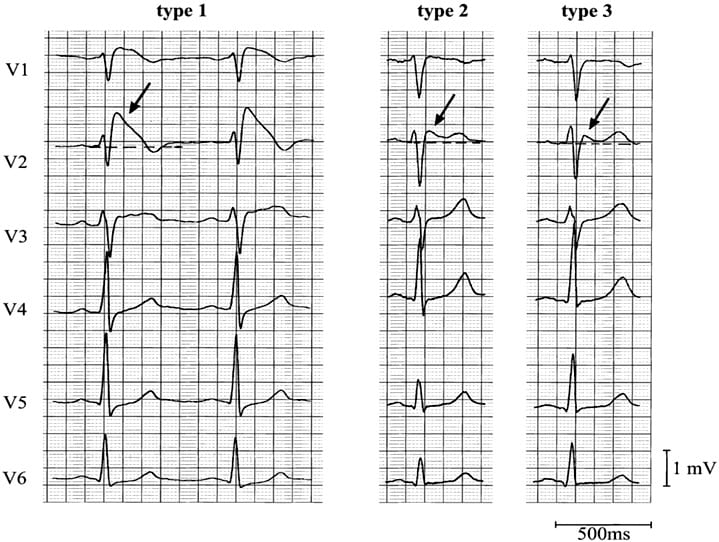 Brugada syndrome types