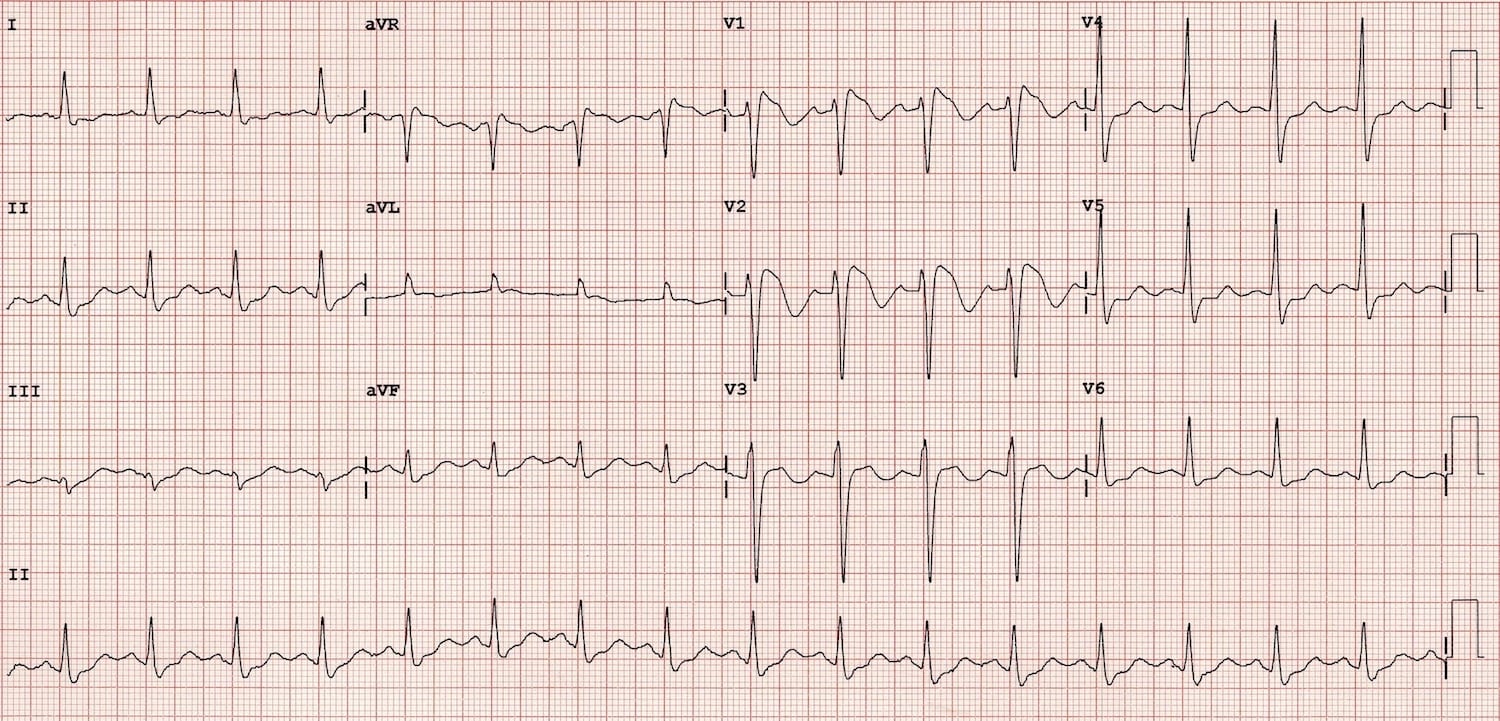 ECG Brugada Syndrome Type 1 2
