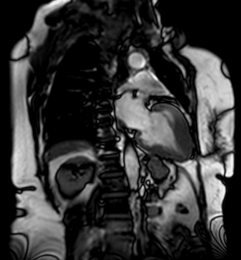 Cardiac MRI Yamaguchi syndrome