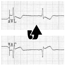 ECG aVL flip Inferior STEMI
