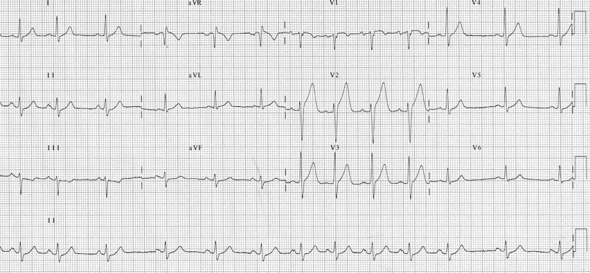 ECG Sinus arrhythmia 12 lead