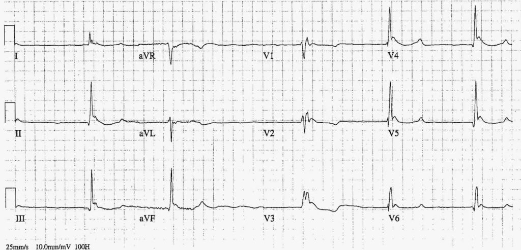 ECG Case 074 Top 100