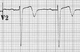 ECG Wellens Type A V2 biphasic T wave