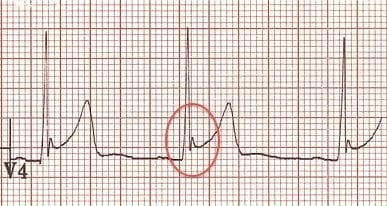 Fish hook benign early repolarisation