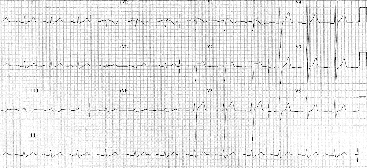 Brugada syndrome type 3