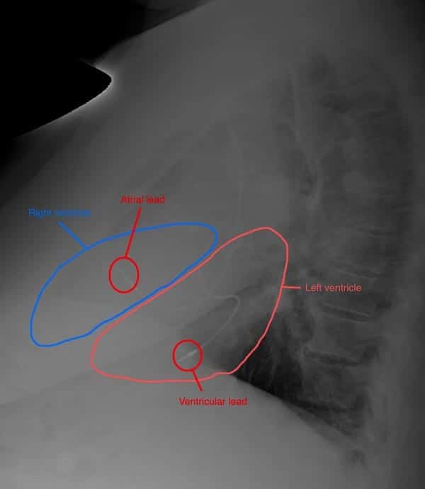 ECG Case 111 Lat CXR Post PPM labelled