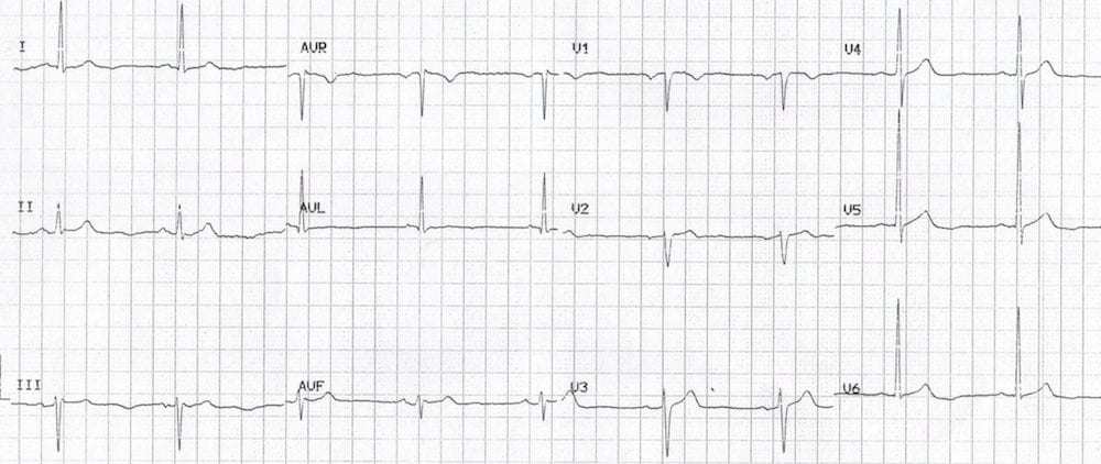 ECG lateral U wave inversion Something Sinister