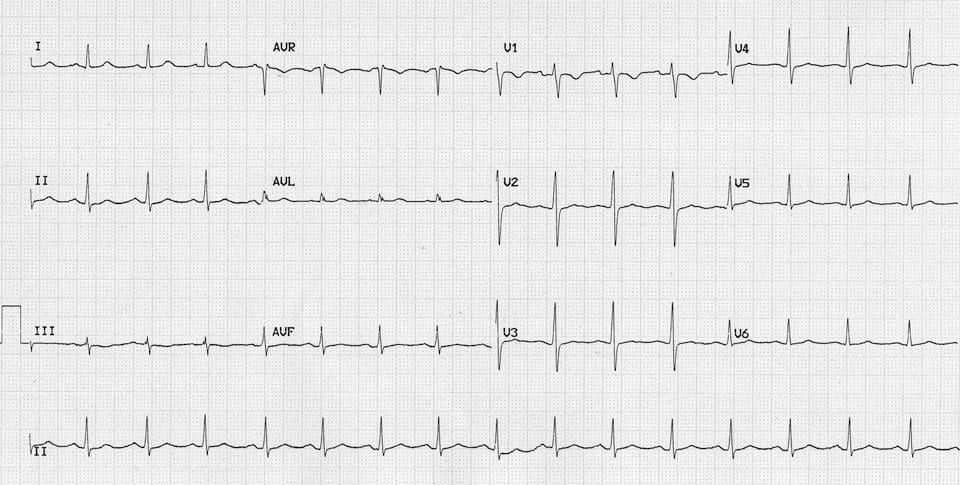 ECG Massive Carbemazepine OD 2