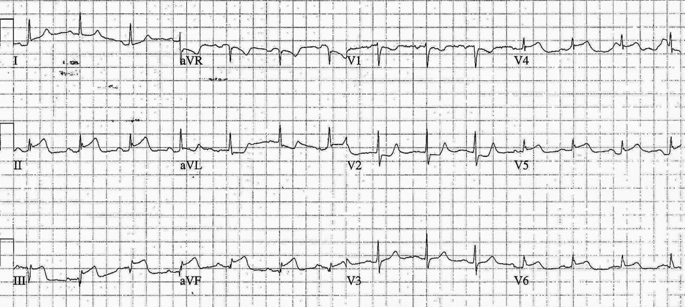ECG Case 081b LITFL Top 100 EKG