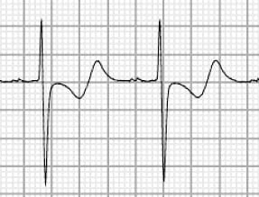 Biphasic T waves due to hypokalaemia