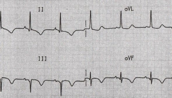 Inferior T wave inversion with Q waves