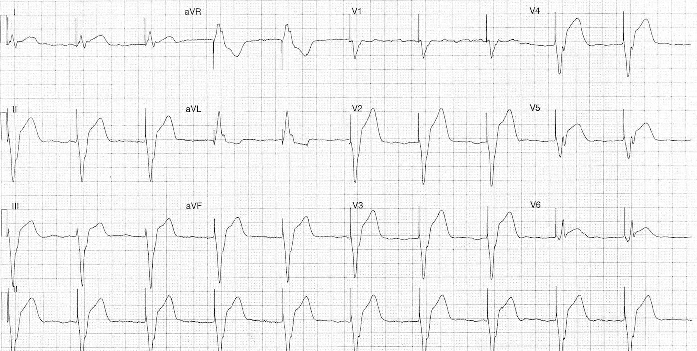 ECG Case 084b LITFL Top 100 EKG