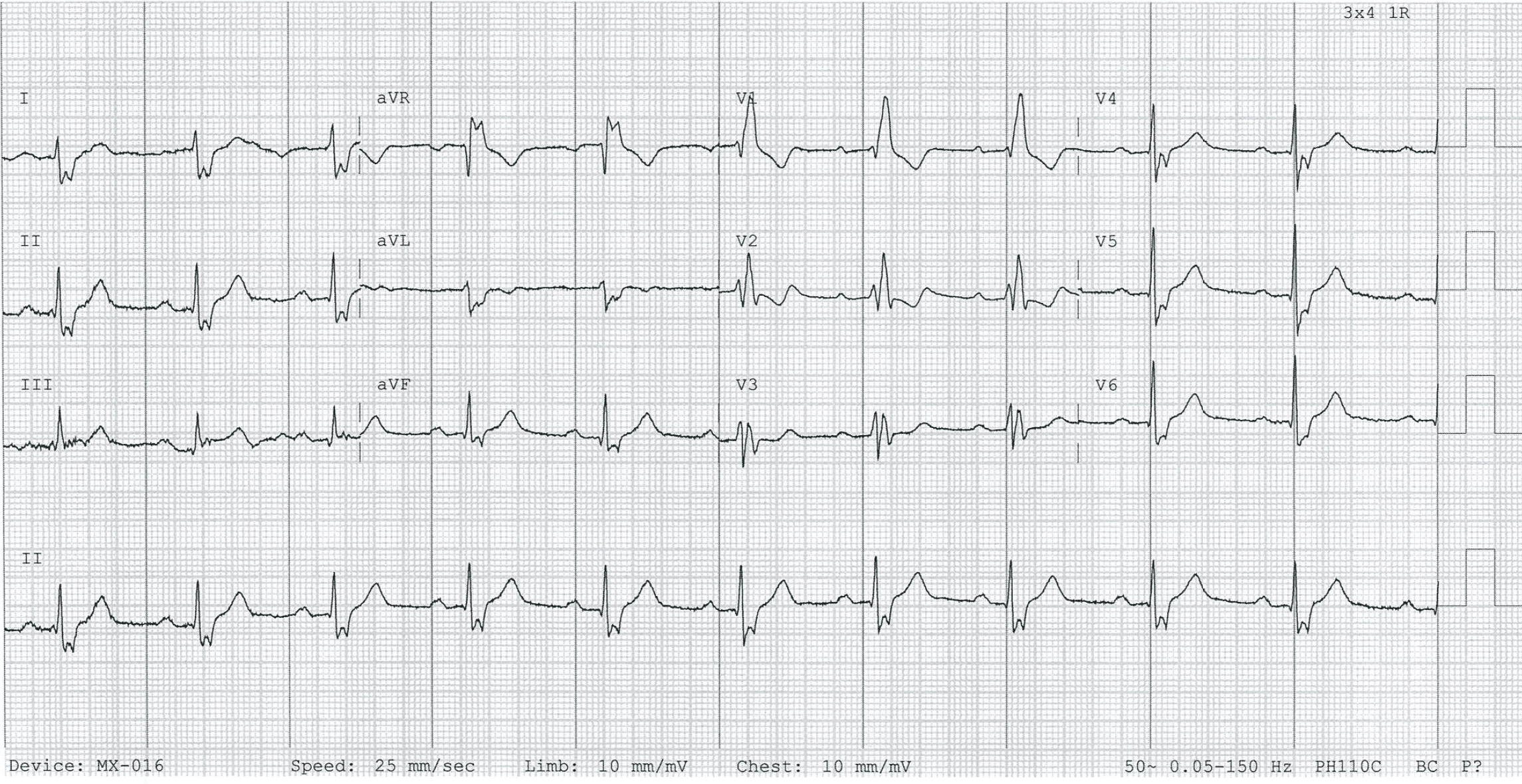 Bifascicular block RBBB LPFB RAD