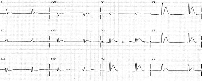 short_qt_hypercalcaemia