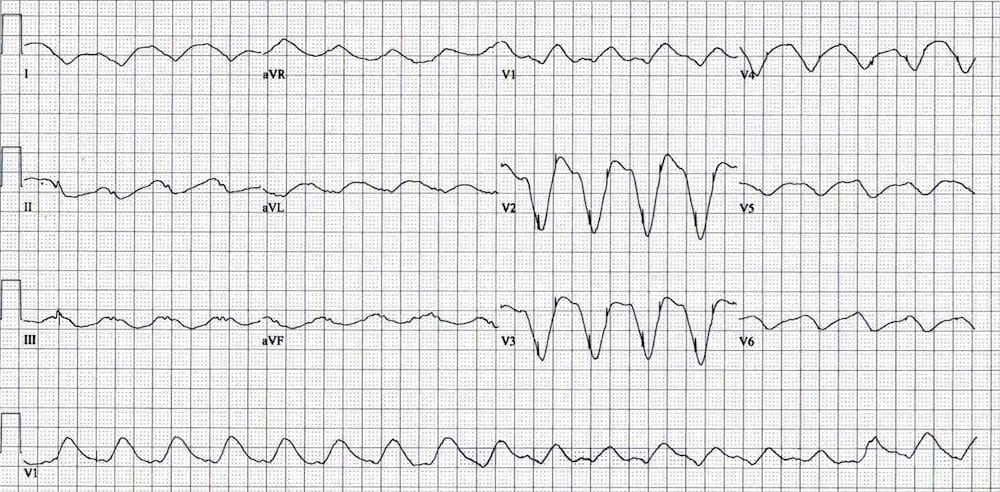 ECG Exigency 016 Pacemaker Panic 001
