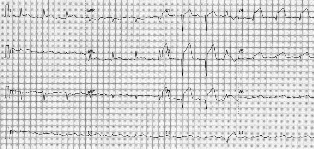 TOP 100 ECG QUIZ LITFL 009 2b