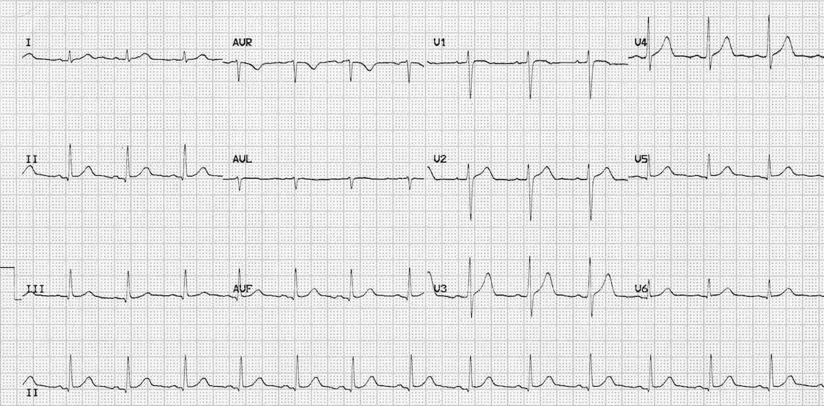 ECG Normal sinus rhythm