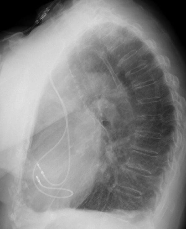 ECG Case 111 Lat CXR PPM Normal