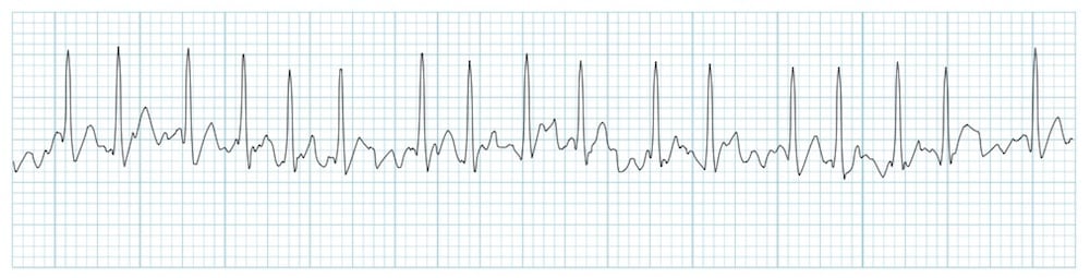 Rhythm Strip LITFL Atrial Fibrillation