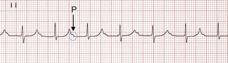 ECG Rhythm strip PR interval prolonged extreme 1st degree AV block