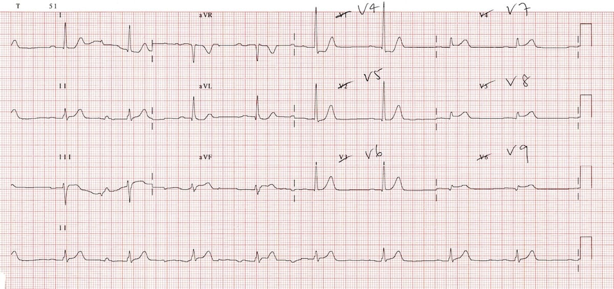 ECG Posterior AMI 2a V789