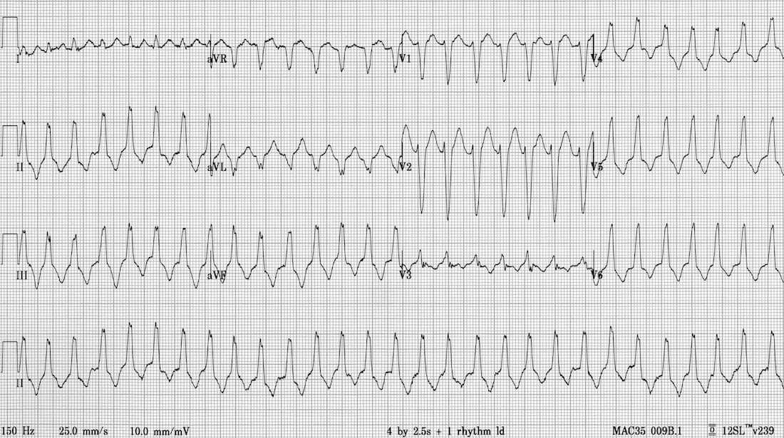 TOP 100 ECG QUIZ LITFL 048 2