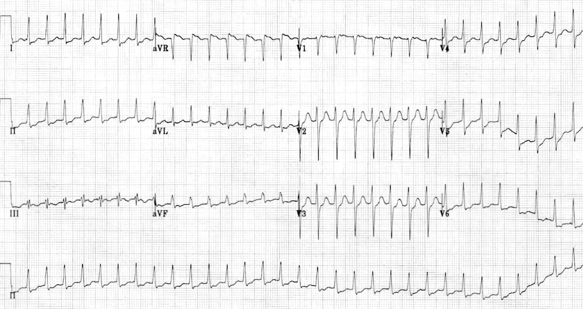 ECG SVT with ST depression