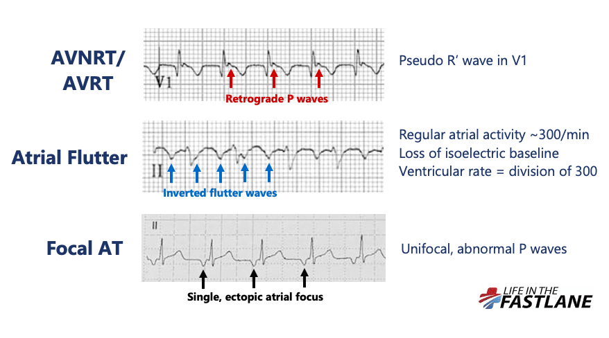 Differential diagnosis for regular narrow complex tachycardia