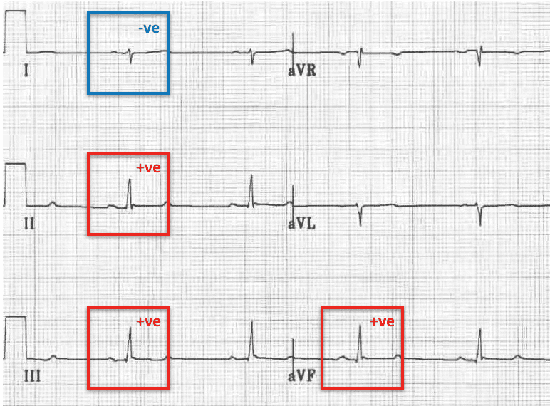 Left Posterior Fascicular Block (LPFB) Right axis deviation