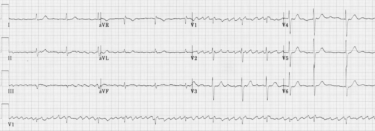 Digoxin toxicity Regularised atrial fibrillation AF