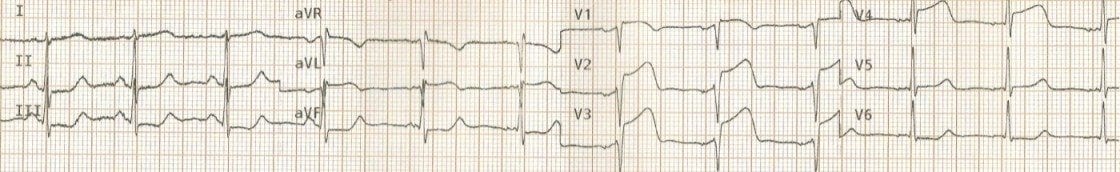 TOP 100 ECG QUIZ LITFL 005 4