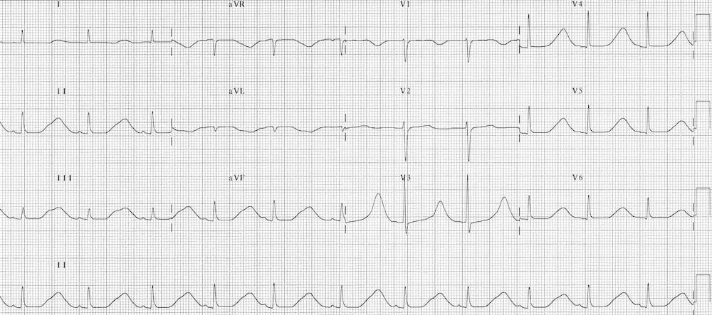 ECG Hypocalcaemia prolonged QTc