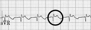 Upright retrograde P waves in aVR