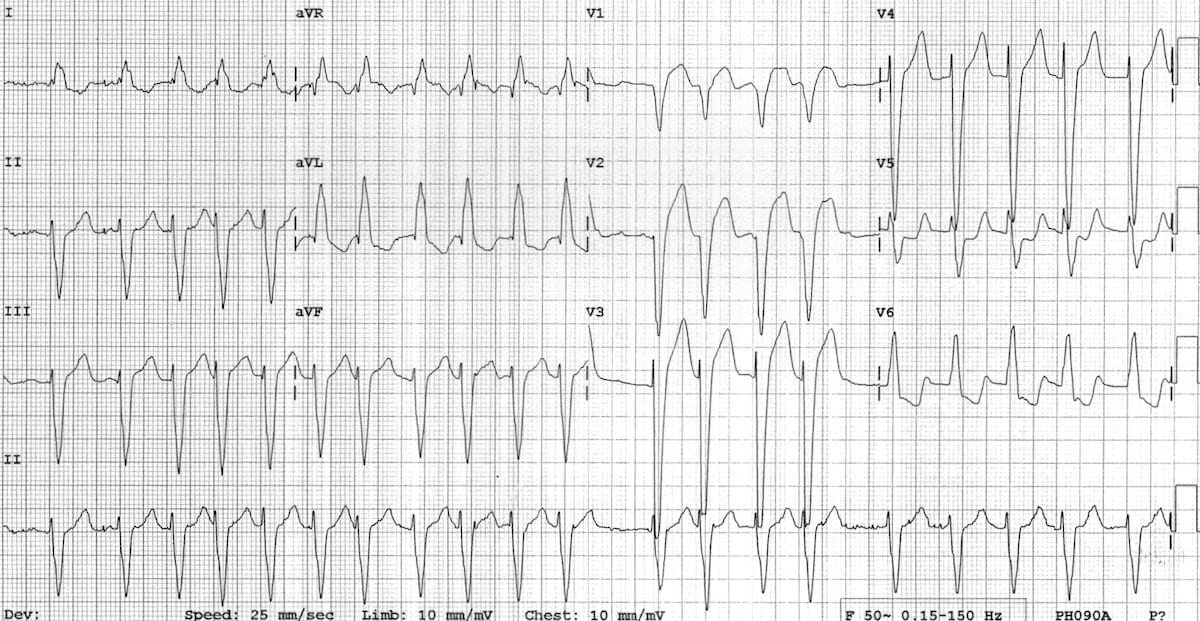 ECG Dilated cardiomyopathy Atrial fibrillation LBBB