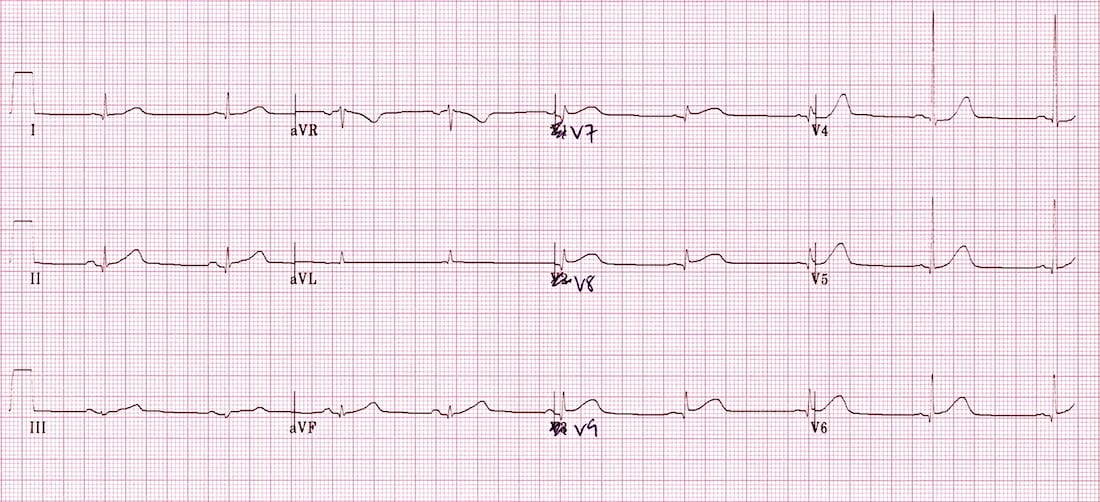 ECG Posterior AMI 3 V789