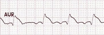 ST elevation in aVR in LMCA occlusion