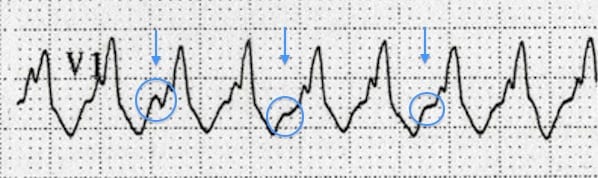 ECG VT AV dissociation