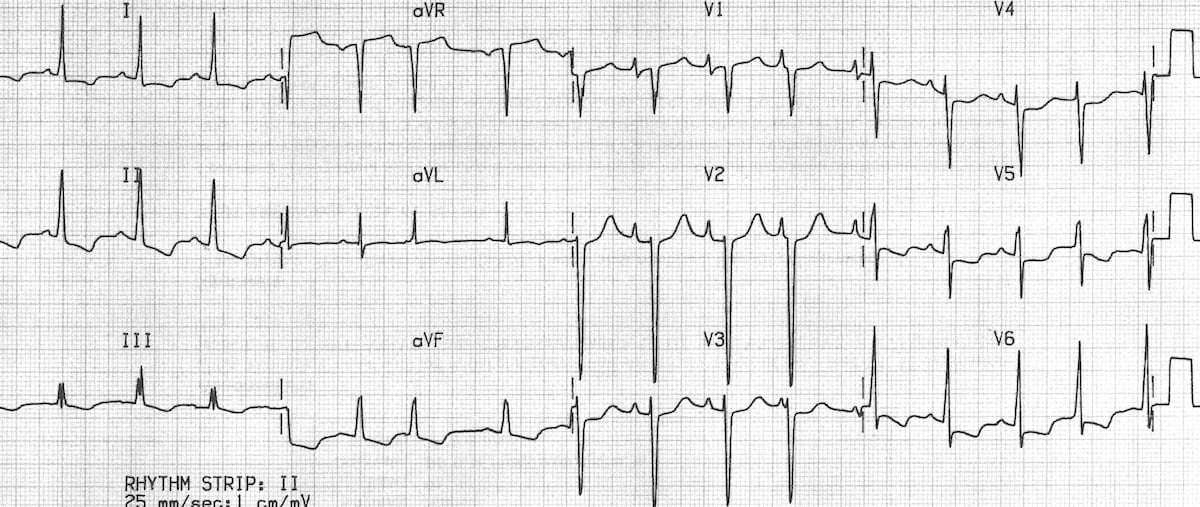 ECG Idiopathic dilated cardiomyopathy Biatrial hypertrophy