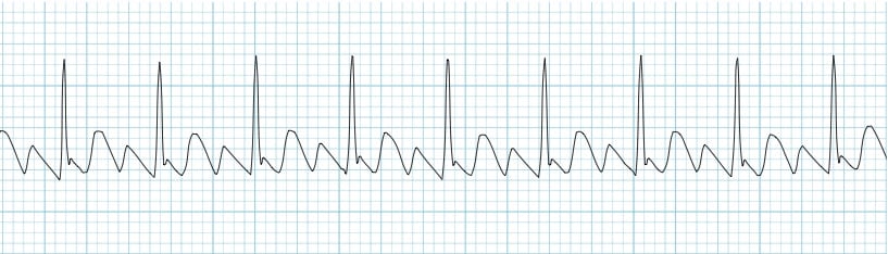 ECG Strip Atrial flutter