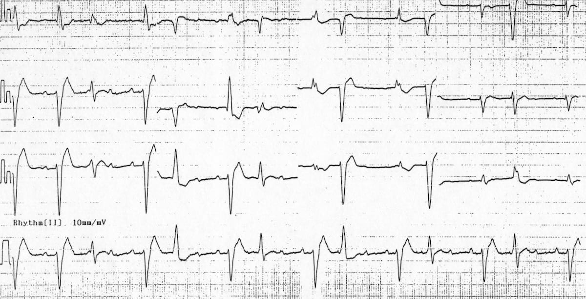 Digoxin Toxicity atrial tachycardia with block and frequent PVC