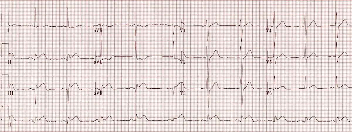 ECG Inferior AMI STEMI