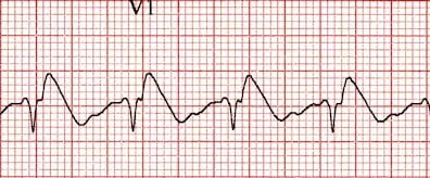 Pseudo-Brugada pattern in V1
