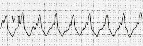 RBBB-like-morphology