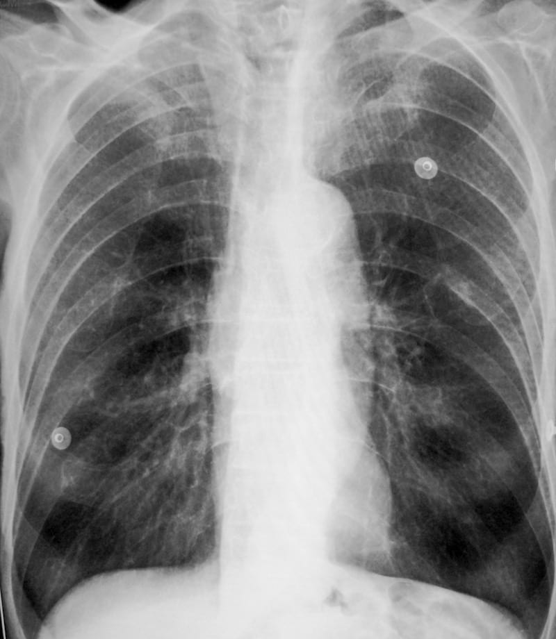 CXR COPD Vertical Heart 800